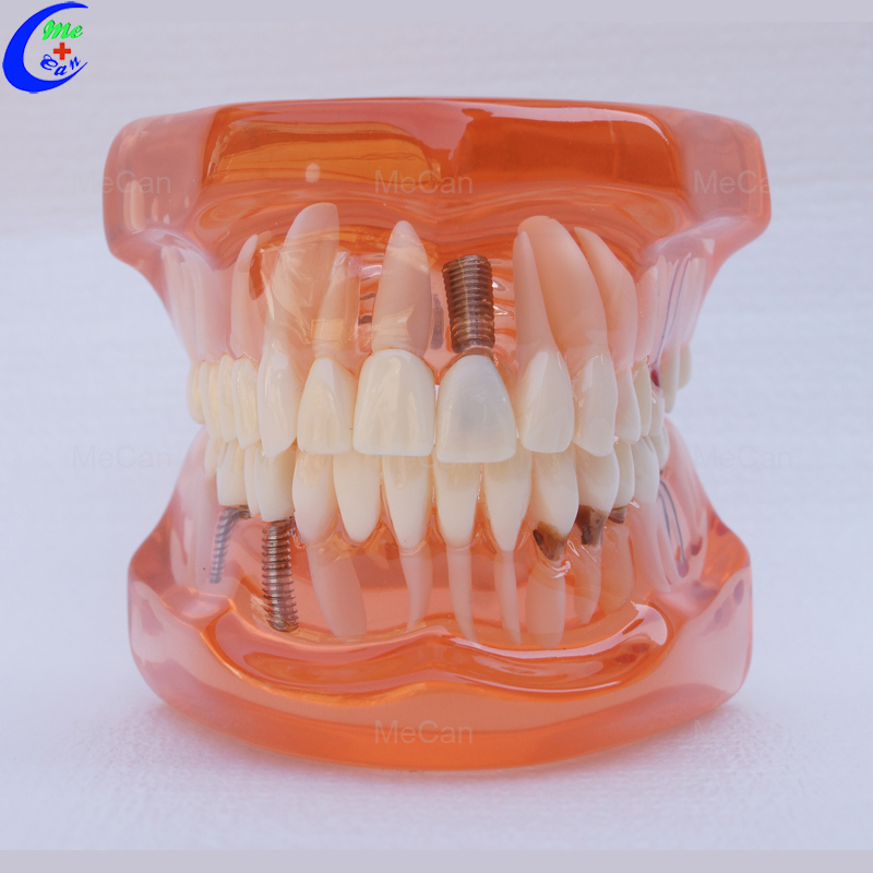 Plastic Dental Model of Teeth, Restoration with Implant