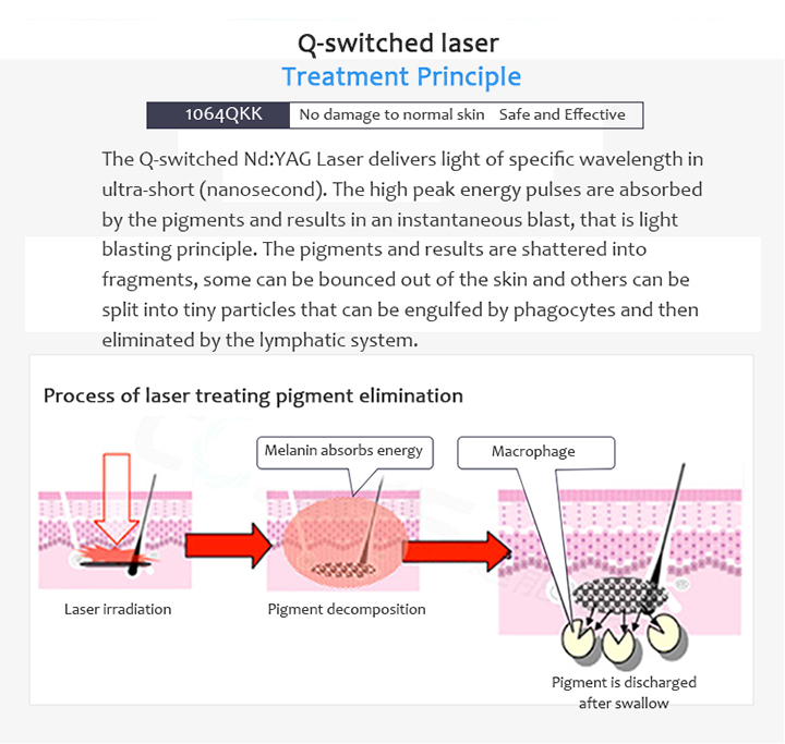 Honkon Tattoo Removal Q-Switched ND YAG for Beauty Salon Equipment