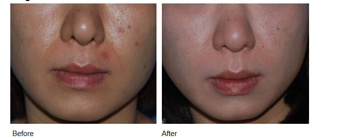 Lip Augmentation Lip Filling Lip Correction Lip Filling Singderm