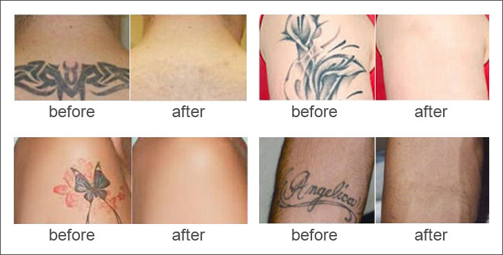 ND YAG Laser Q Switch Tattoo Removal Beauty Machine Equipment Price