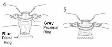 Disposable Wound Retractor for Abdominal Open Surgery