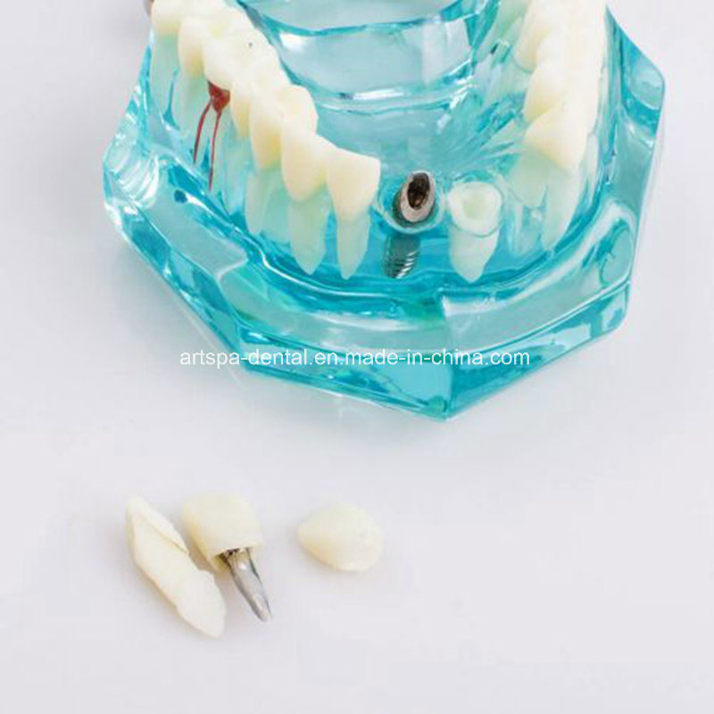 Dental Study Tooth Transparent Adult Pathological Teeth Model