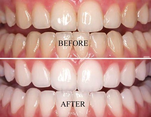 Bleaching White Oral Care Teeth Whitening Kit with FDA Approved