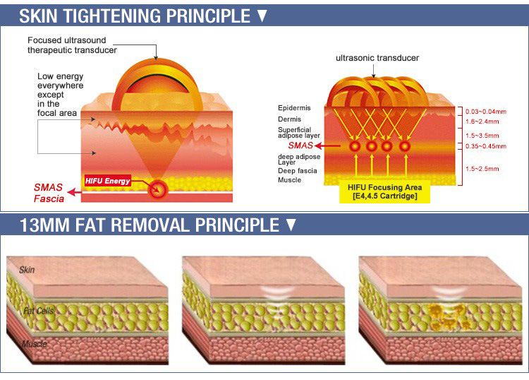 Ultrasound Hifu Machine for Face Wrinkle Removal Skin Tighten and Body Weight Loss