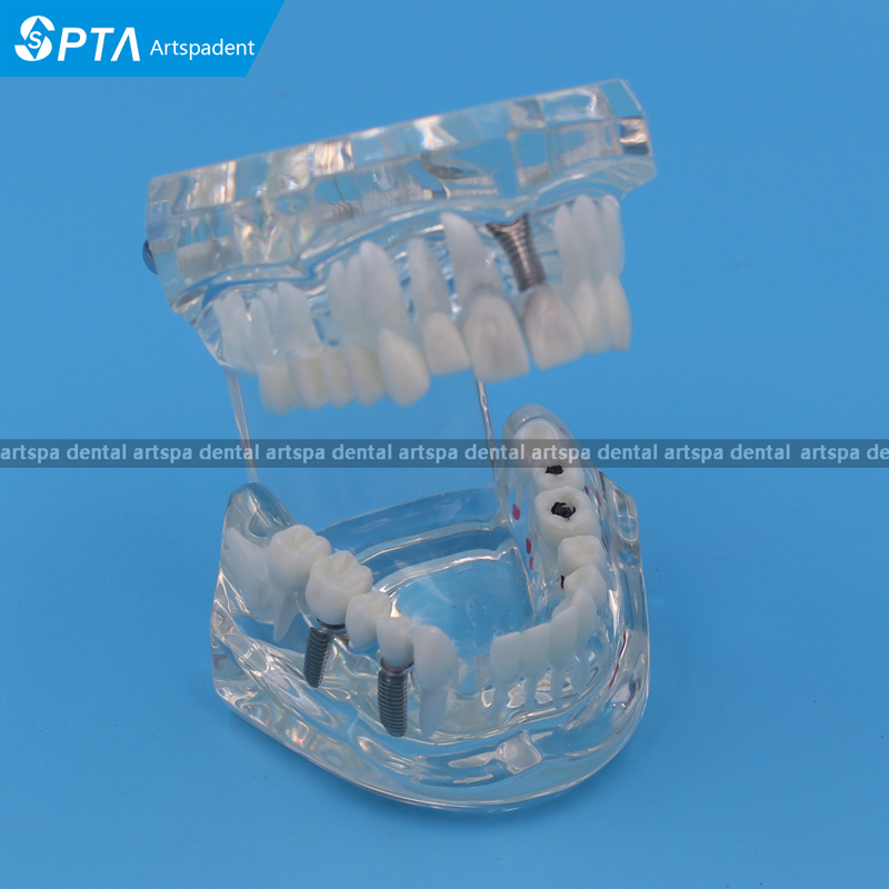 Dental Implant Disease with Restoration & Bridge Tooth Teeth Model