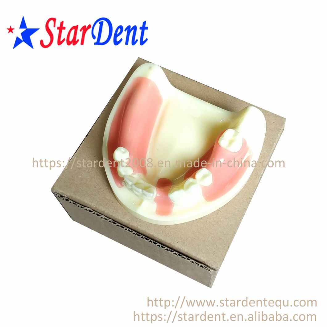 Dental Teeth Implant Practice Model