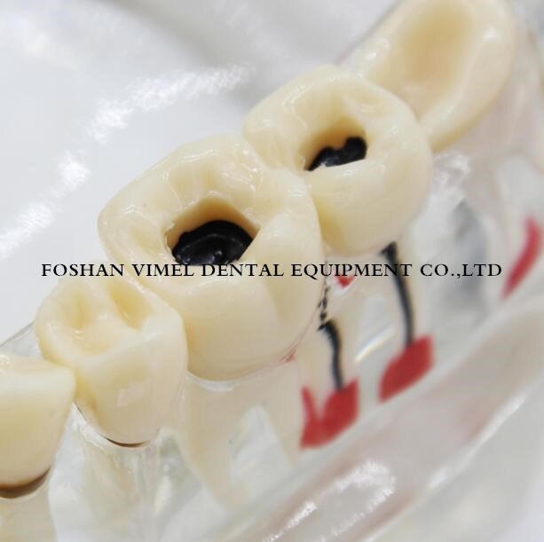 Dental Study Tooth Transparent Pathological Teeth Model for Adult Teaching