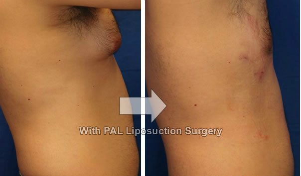 Professional Surgical Power Assisted Liposuction