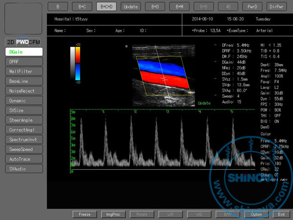 Color Doppler Ultrasound (DopScan 8000)