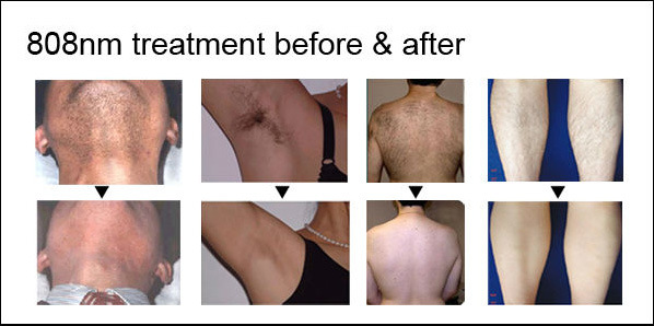 Top Quality Professional 808nm Permanent Hair Removal