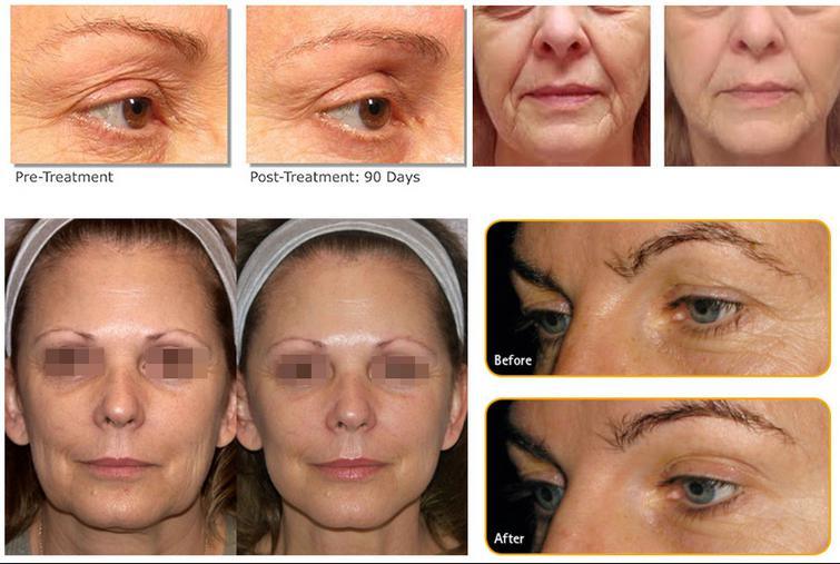 10000/20000 Shots Face Body Hifu Skin Rejuvenation Skin Tigten Anti Aging Body Slimming Machine