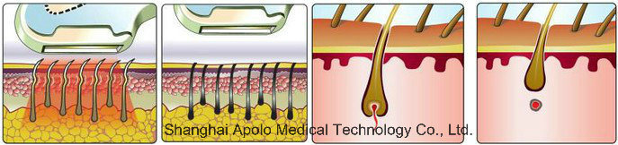 Hair Removal Super IPL Laser Shr Machine / Opt Shr Beauty Equipment