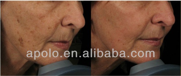 Apolomed 10600nm CO2 Laser Skin Resurfacing Technology System