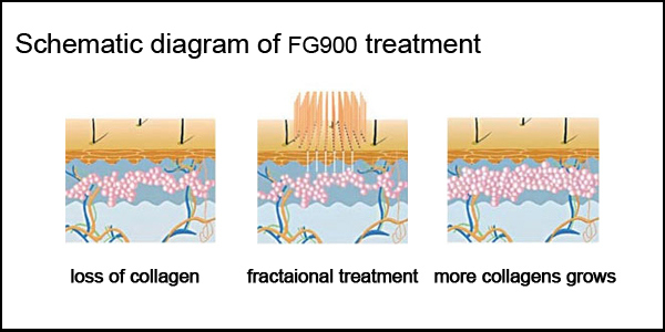 Radio Frequency (RF) Fractional CO2 Laser Equipment (FG900)