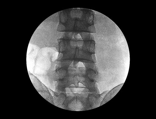 High Frequency Mobile Digital C-Arm X-ray Machine