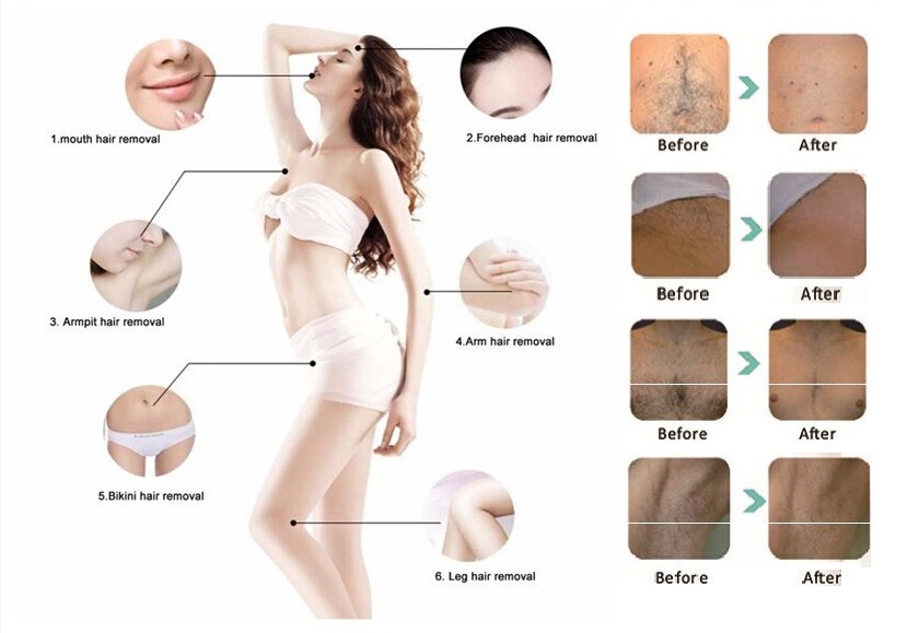 808nm Diode Laser Permanent Hair Removal Price for Sale