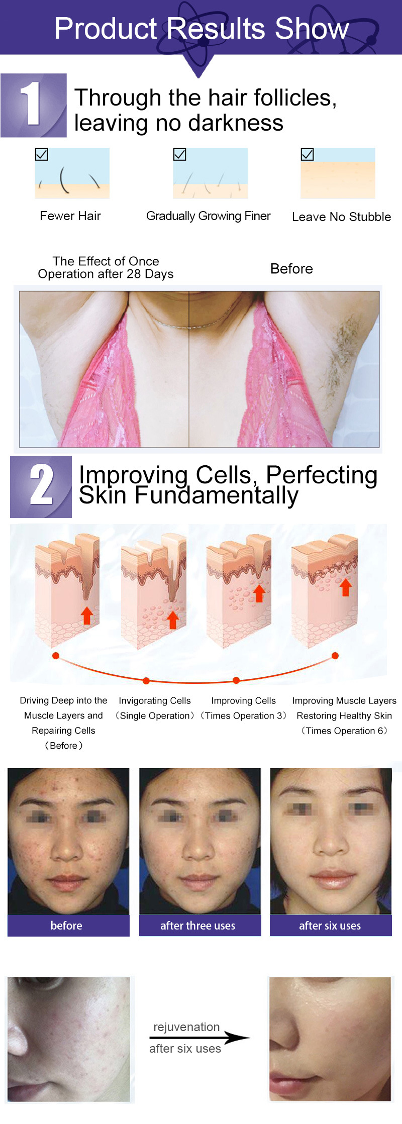 Low Price Painless Treatment Freezing Point Permanent Hair Removal