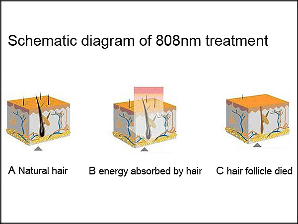 808nm Laser Permanint Painless Hair Removal Machine