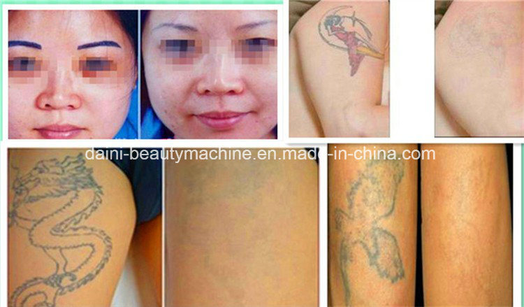 Portable Q Switch ND YAG Laser / Handheld YAG Laser Tattoo Removal