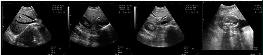 Medical Ultrasound for Hospital and Clinic Use on Human 3W-5100