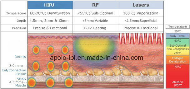 Deep Wrinkle Removal Hifu Body Sculpt High Intensity Ultrasound