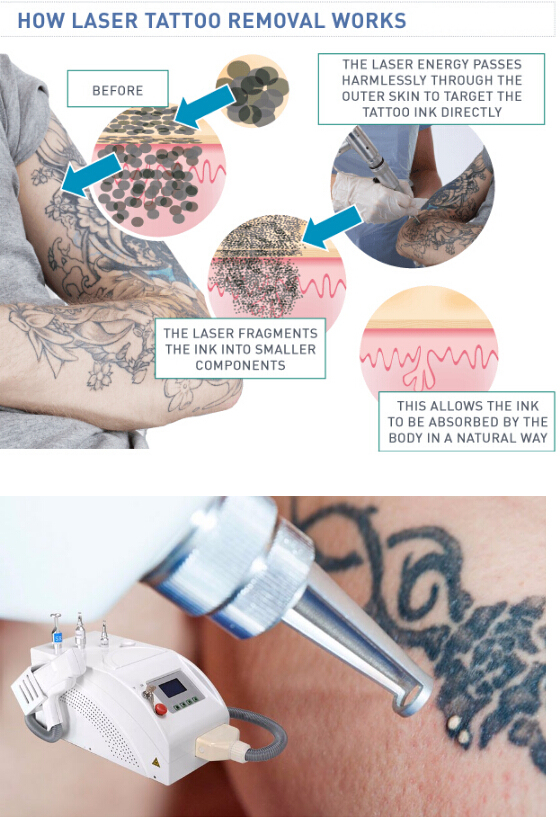 1064nm/532nm Mini Portable Laser Tattoo Removal