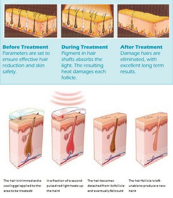 Filters Changeble Professional IPL E-Light for Hair Removal and Skin Rejuvenation