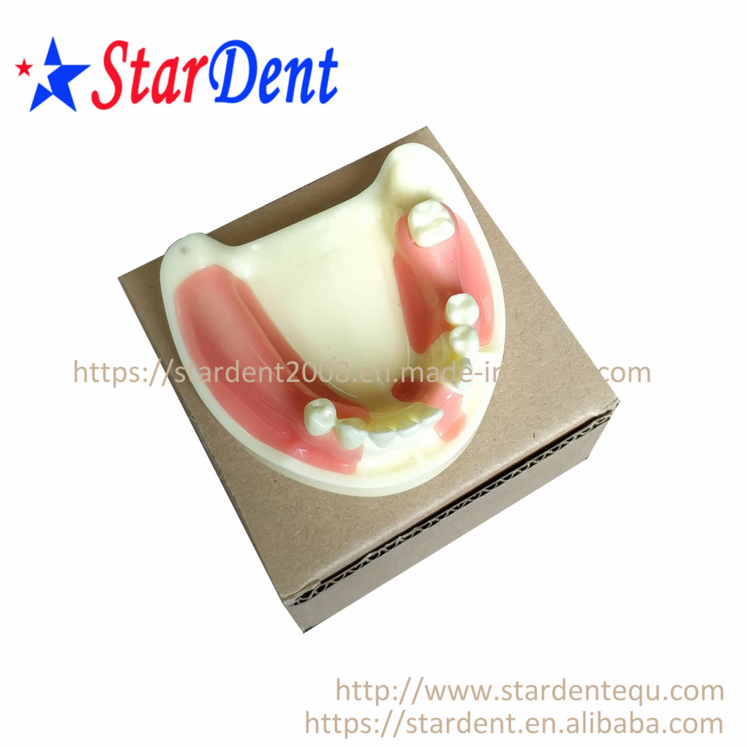 Dental Teeth Implant Practice Model