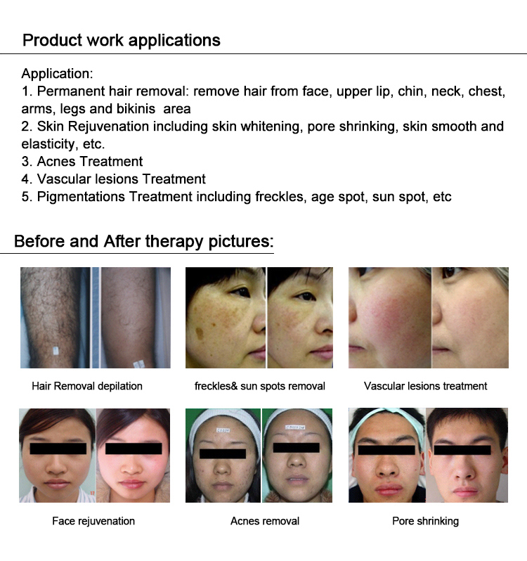 E-Light IPL RF Skin Rejuvenation for Hair Removal Machine