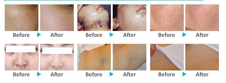 2 in 1 IPL Skin Rejuvenation Shr Hair Removal Beauty Machine
