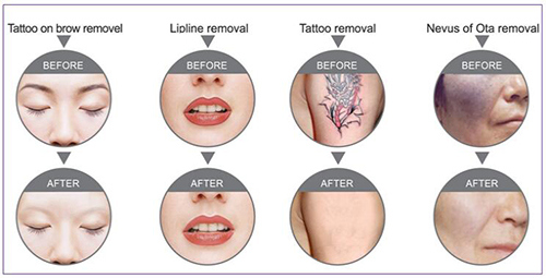 YAG Laser Tattoo Removal Machine