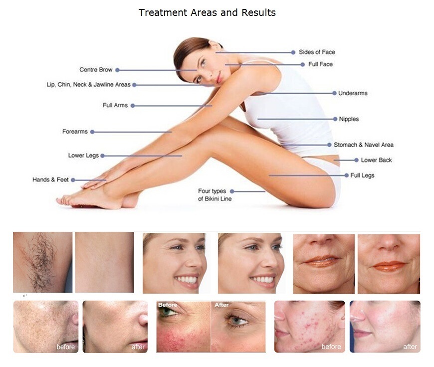 Freckle Removal and Skin Rejuvenation IPL Shr Beauty Machine
