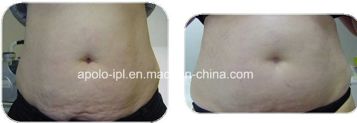 Vacuum Cavitation Cellulite Treatment Slimming Machine