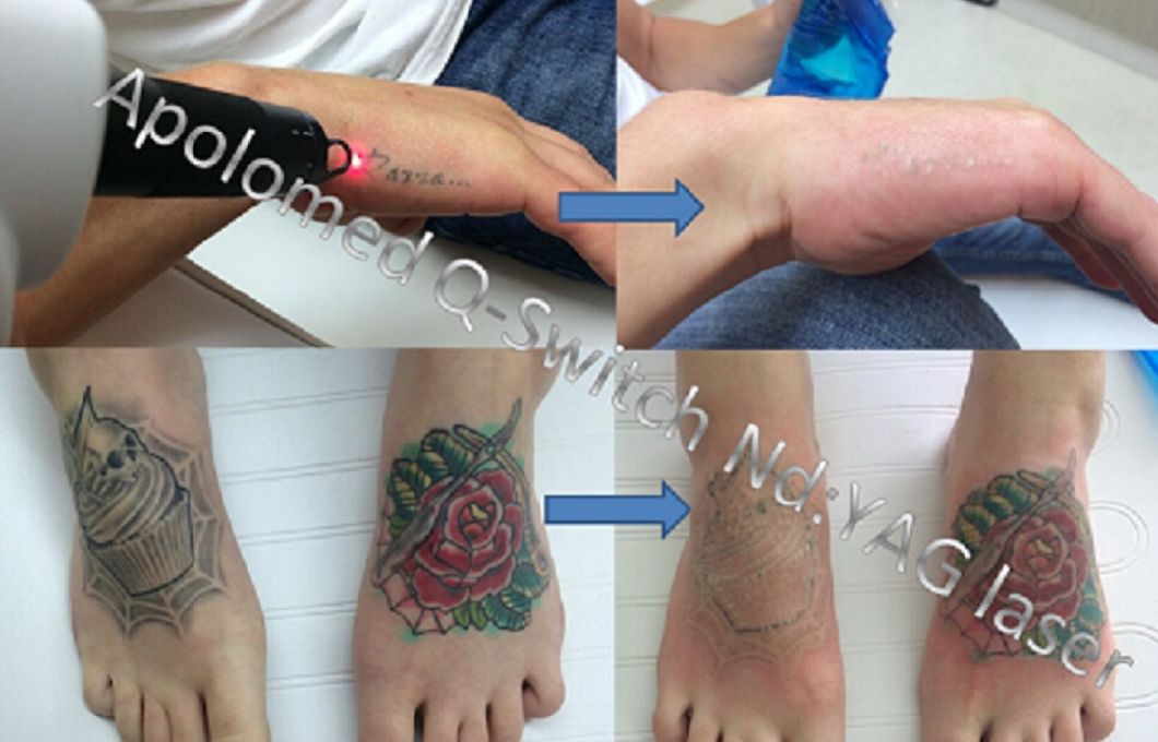 The Best Portable Q Switch ND YAG Laser Tattoo Removal Machine Prices