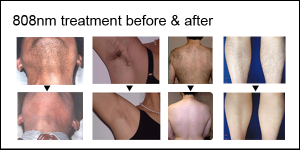 Lightsheer Diode Laser Permanent Hair Removal