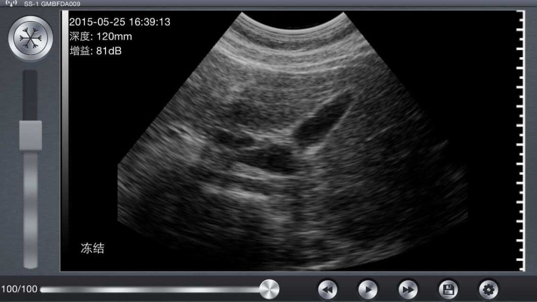 Determination Obstetric Ultrasound Diagnosis of Fetal Gender/Unborn Baby Gender