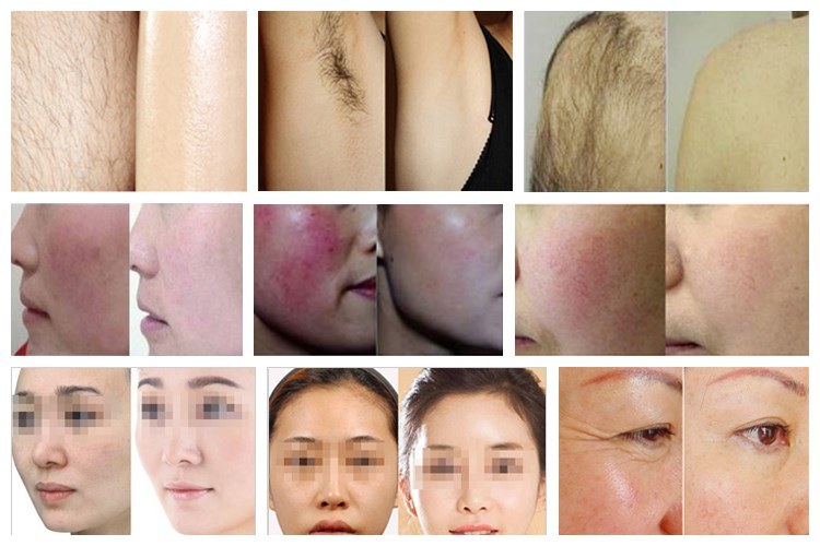 New Product and Professional Shr Opt IPL Laser Hair Removal Fast/ Skin Rejuvenation Beauty Machine