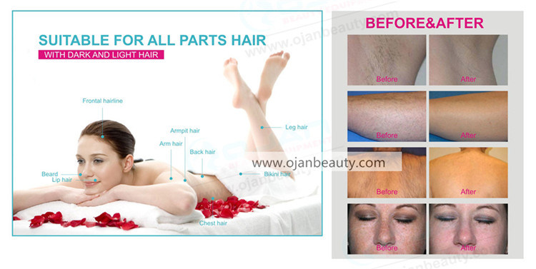 Medical Ce Approved 808nm Laser Diode for Hair Removal