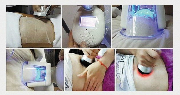 Popular Lipo Body Slimming Cryo + Laser + RF + Cavitation Fat Freezing Machine
