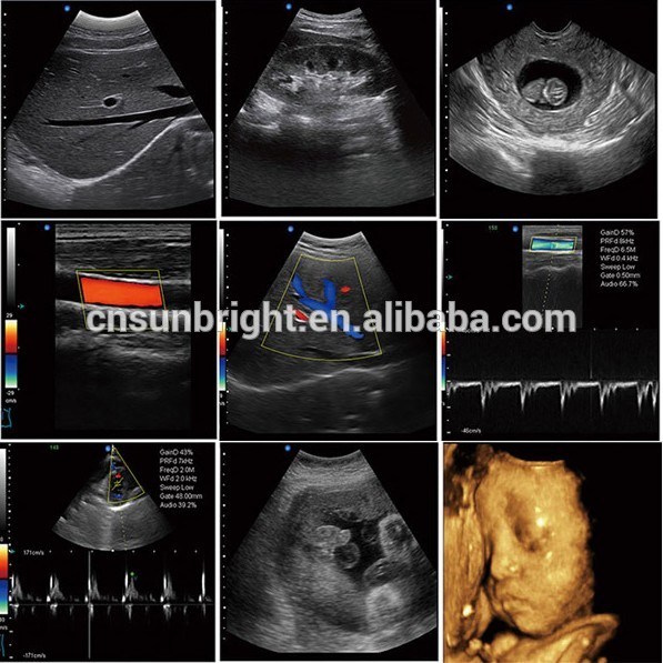 15 Inches LED Display 3D/4D Laptop Color Doppler Ultrasound