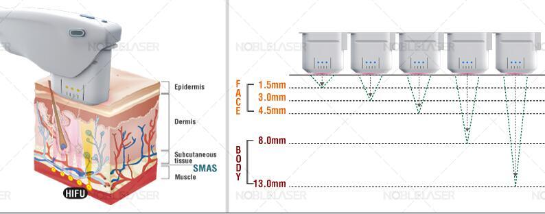 Hifu Face Lifting and Body Shaping Machine (CE)