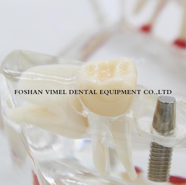 Dental Study Tooth Transparent Pathological Teeth Model for Adult Teaching