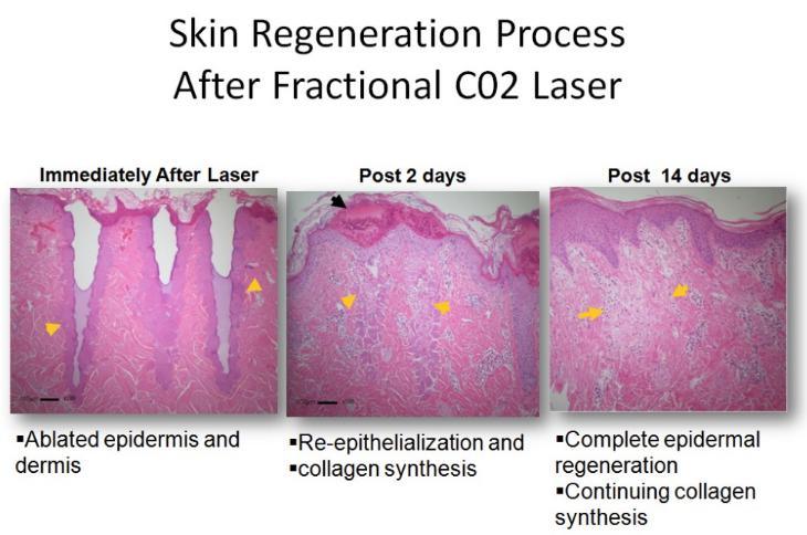 2016 Fractional CO2 Laser Skin Care and Scar Removal Equipment
