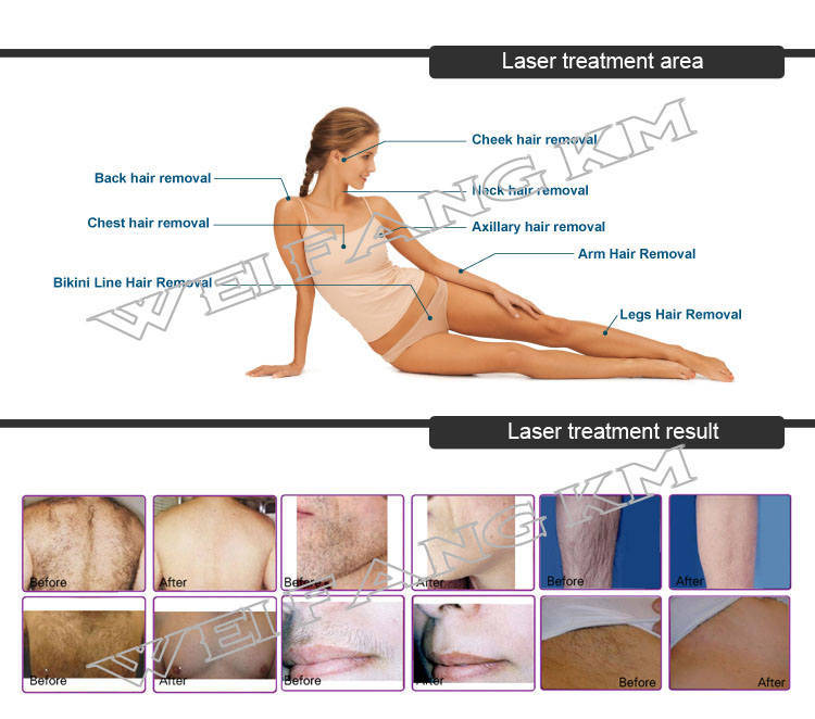 12 Bars Medical Ce 808nm Diode Laser Machine Epilator Equipment