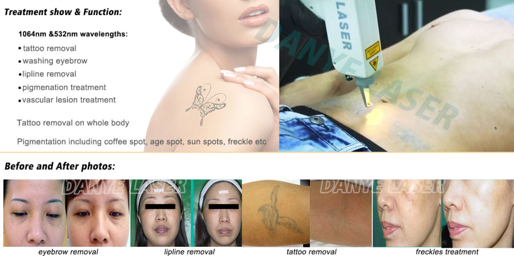 Portable Q Switched ND YAG Laser Tattoo Removal Machine for Body Tattoo, Eyebrow, Lipline Removal