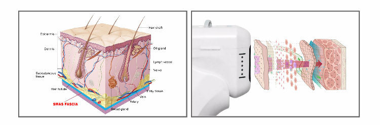 OEM ODM Factory Price Wholesale Body Hifu Slimming Machine Price for Face Lifting