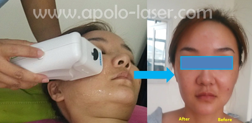 Popular Wrinkle Removal Hifu for Facial Lifting and Hifu Anti Aging