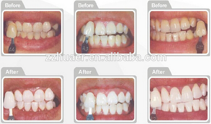 Luxsmile Home Whitening Kit Bleaching Take Easy Teeth Whitening Bleaching