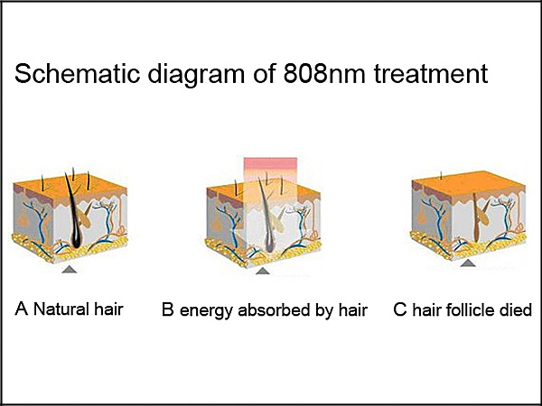 808nm Diodes Laser Soprano Laser Hair Removal Machine (FG2000-C)