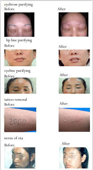 ND YAG Laser Tattoo Removal Machine